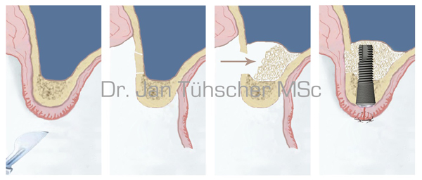 Ablauf des externen Sinusliftes