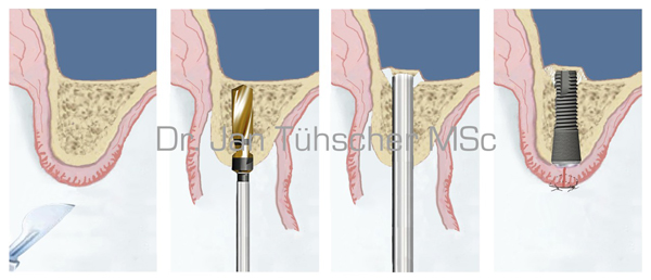 Interner Sinuslift