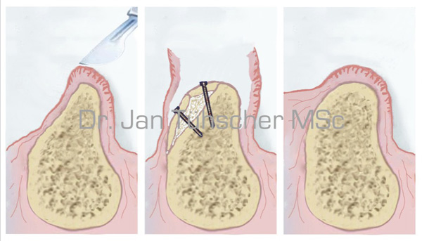Knochentransplantation mit Verschalungstechnik
